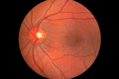 Patologie retina